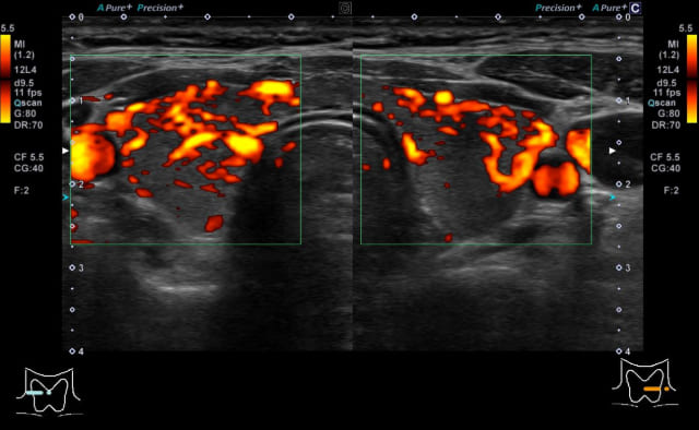 甲状腺_バセドウ病