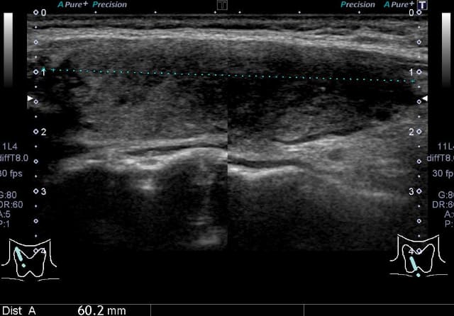 甲状腺のしこり・腫大_亜急性甲状腺炎