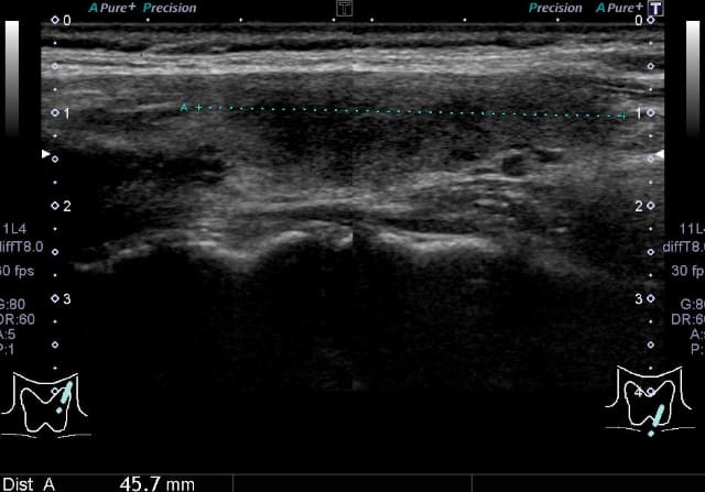 甲状腺のしこり・腫大_亜急性甲状腺炎2