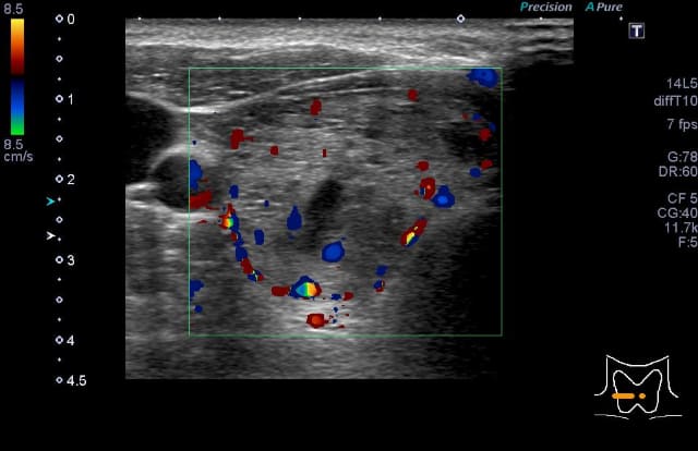 甲状腺のしこり・腫大_プランマー病