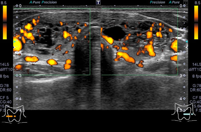 甲状腺のしこり・腫大_機能性結節多発性