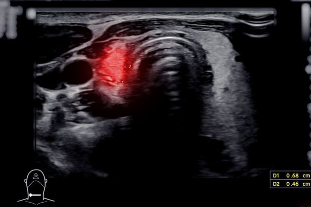 CTでの甲状腺病変のイメージ