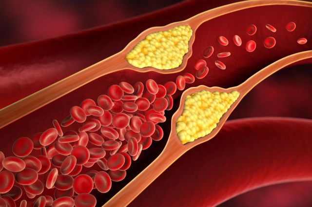 脂質異常症イメージイラスト