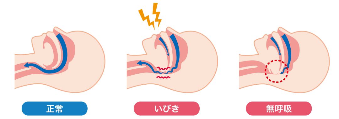 睡眠時無呼吸症候群の状態イラスト