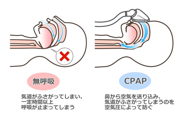 CPAP(持続陽圧呼吸) 療法のイラスト