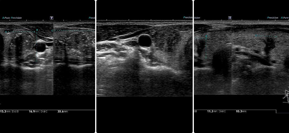 甲状腺乳頭がん