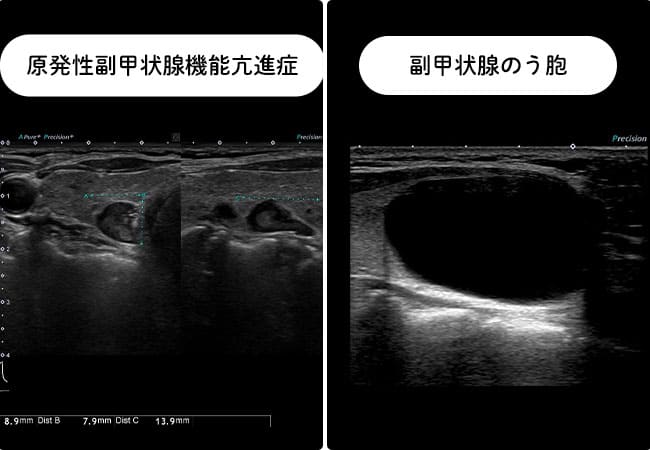 副甲状腺腺腫、のう胞